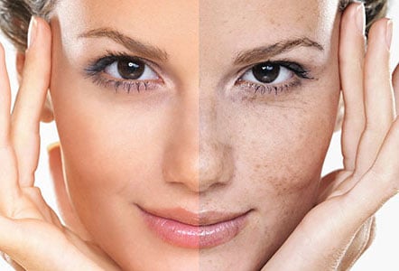 علت تشکیل لک های پوستی و درمان و علل و عوامل لک صورت